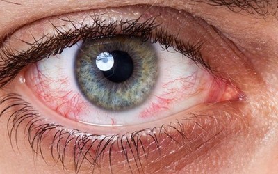 Раздражение слизистой глаз - клиника Веримед