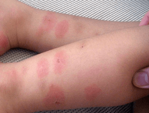 Отек от укусов комаров для детей