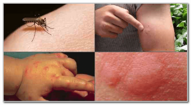 укус комара симптомы