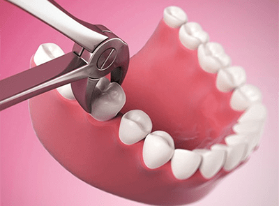 Общий наркоз и удаление зуба
