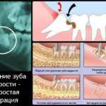 Предполагаемые механизмы формирования кисты зуба