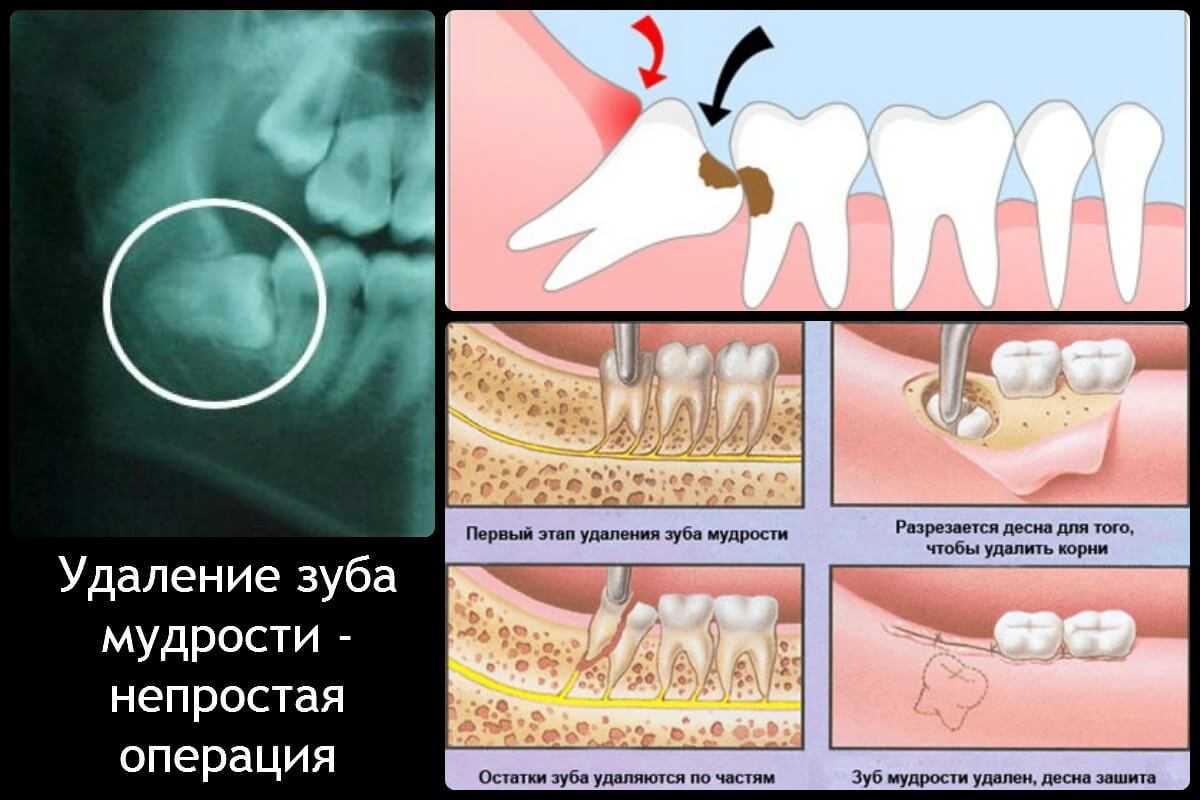 Удаление зуба мудрости: возможные осложнения после процедуры