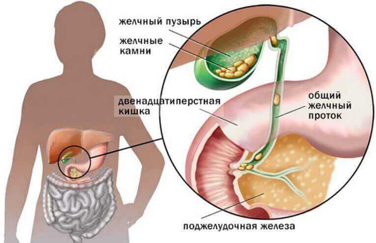 Заболевание холецистит