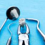 Что нужно знать об имплантации зубов?