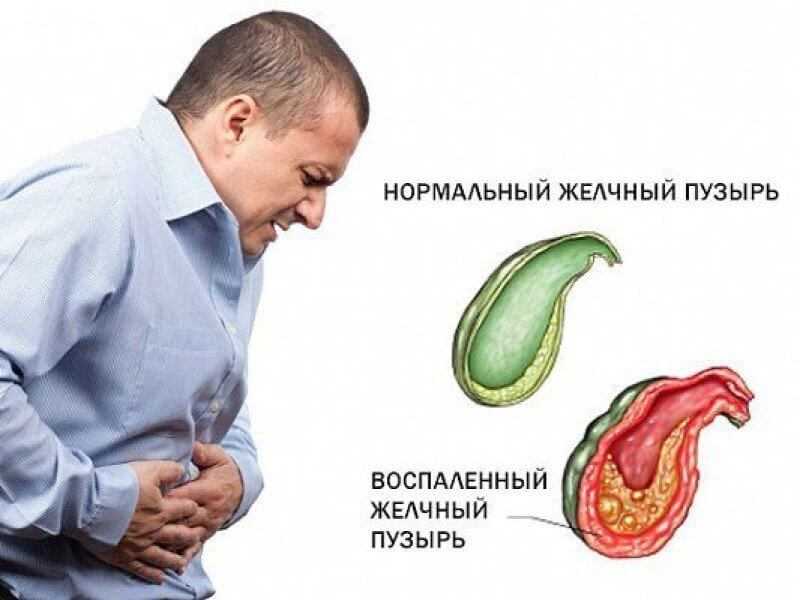 Заболевание холецистит