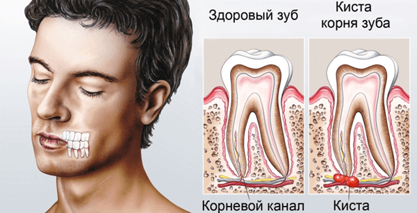 Киста на корне зуба. Лечение заболевания