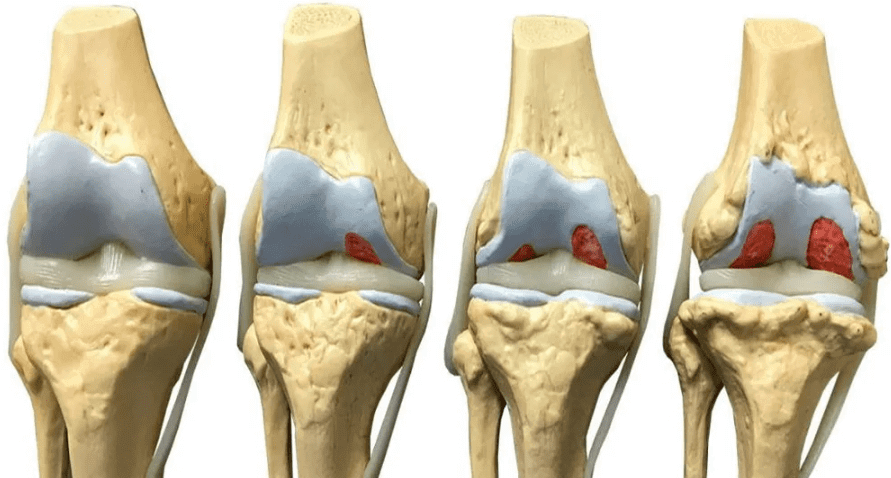 Артроз коленного сустава: этиология и симптомы этого патологического состояния