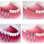 Предоперационная подготовка к имплантации зубов