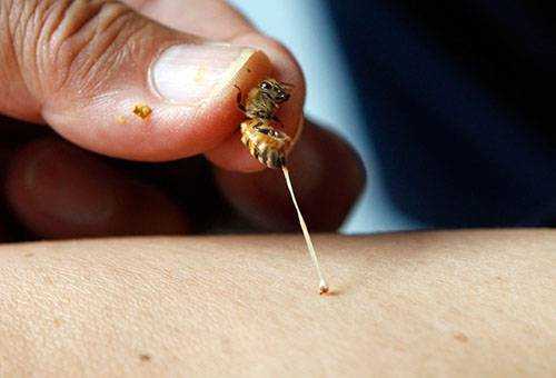 Реакция на укусы пчел — не всегда аллергия, но если аллергия, то опасная