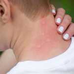 Аллергия на насекомых: чем вредны укусы комаров