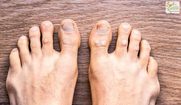 Feet with psoriasis dermatitis
