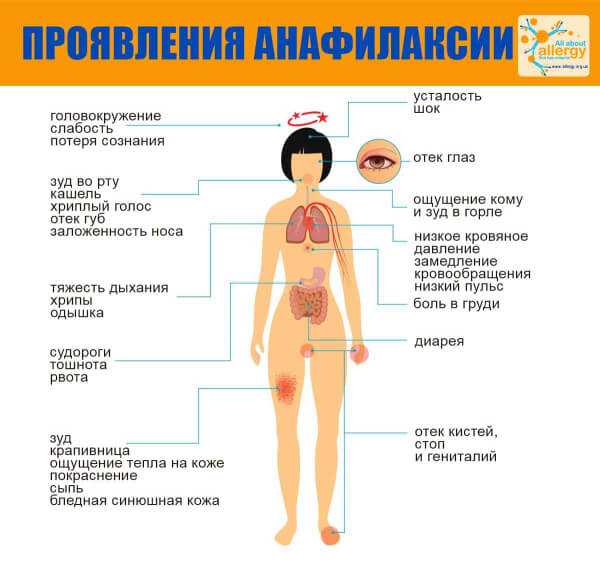 Симптомы анафилаксии инфографика