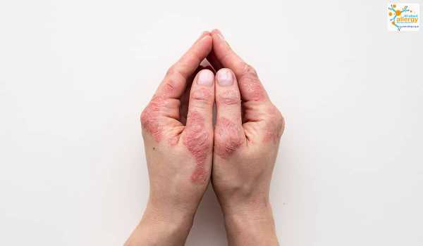 Аллергия на антисептики, или Чем может обернуться забота о чистоте рук