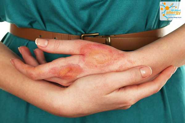 Контактный дерматит: аллергическая реакция или раздражение?