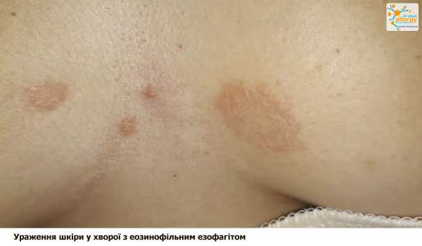 Воспаление пищевода и его связь с пищевой аллергией