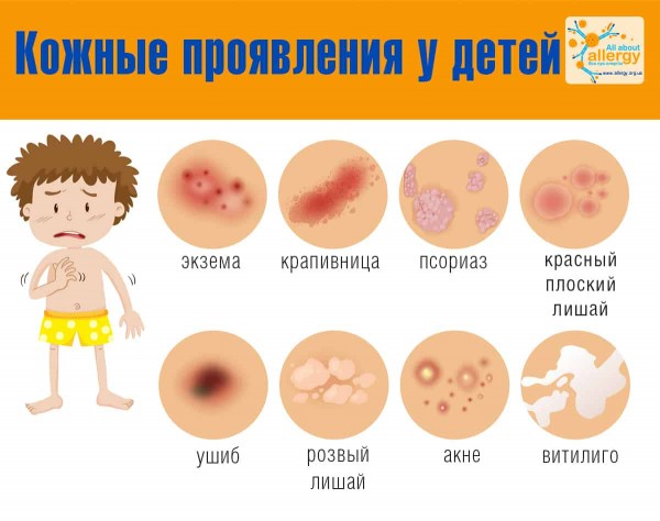 Что делать, если у ребенка возникла аллергия?