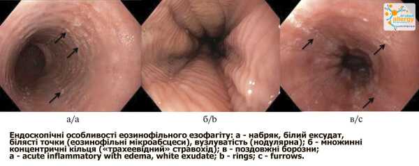Воспаление пищевода и его связь с пищевой аллергией