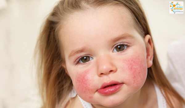 Для установления диагноза аллергии на кунжут лучше проводить молекулярное тестирование