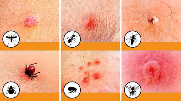 Аллергия на укусы кровососущих насекомых: как проявляется и чем опасна