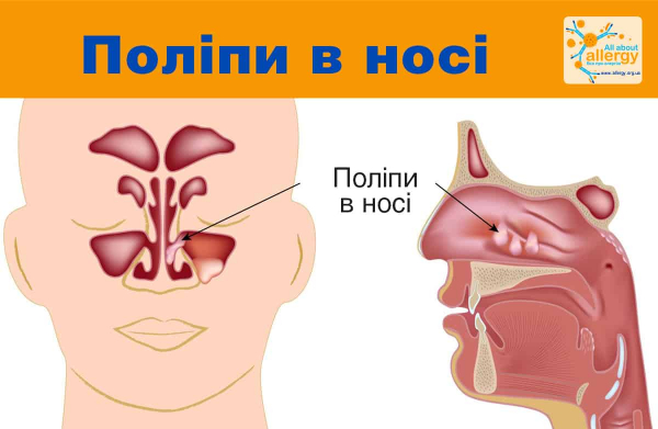 9 причин заложенности носа и головной боли