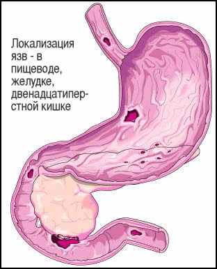 Признаки язвы: на что стоит обратить внимание