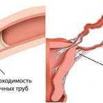 Лазерные технологии в лечении варикозного расширения вен