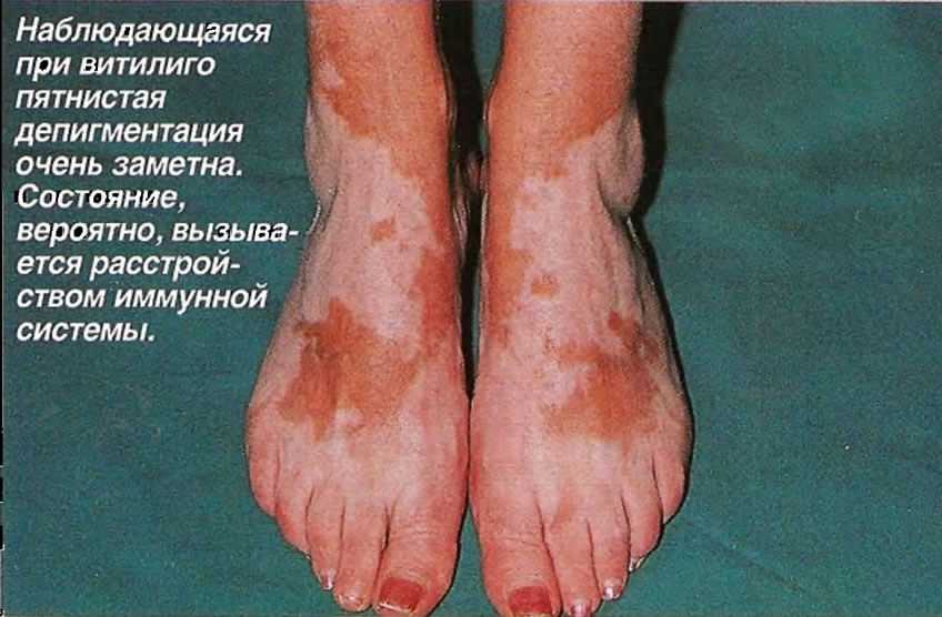 nablyudayuschayasya-pri-vitiligo-pyatnistaya-depigmentaciya-ochen-zametna