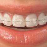 Какие брекеты выбрать?