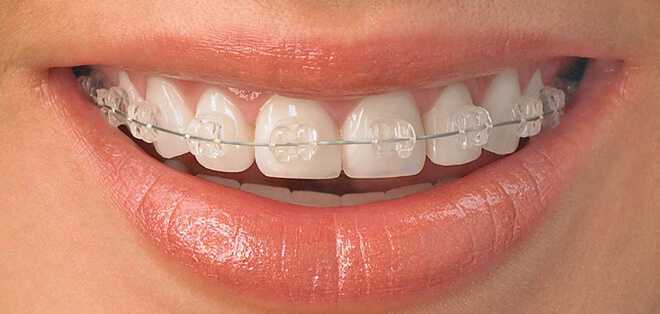 Что такое брекеты и как они работают